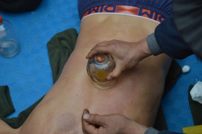 cupping